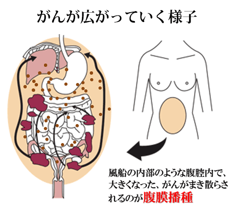 がんが広がっていく様子