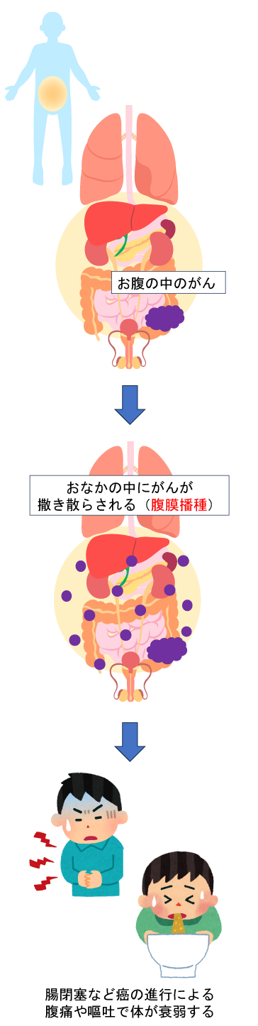 がんがお腹の中で広がる様子