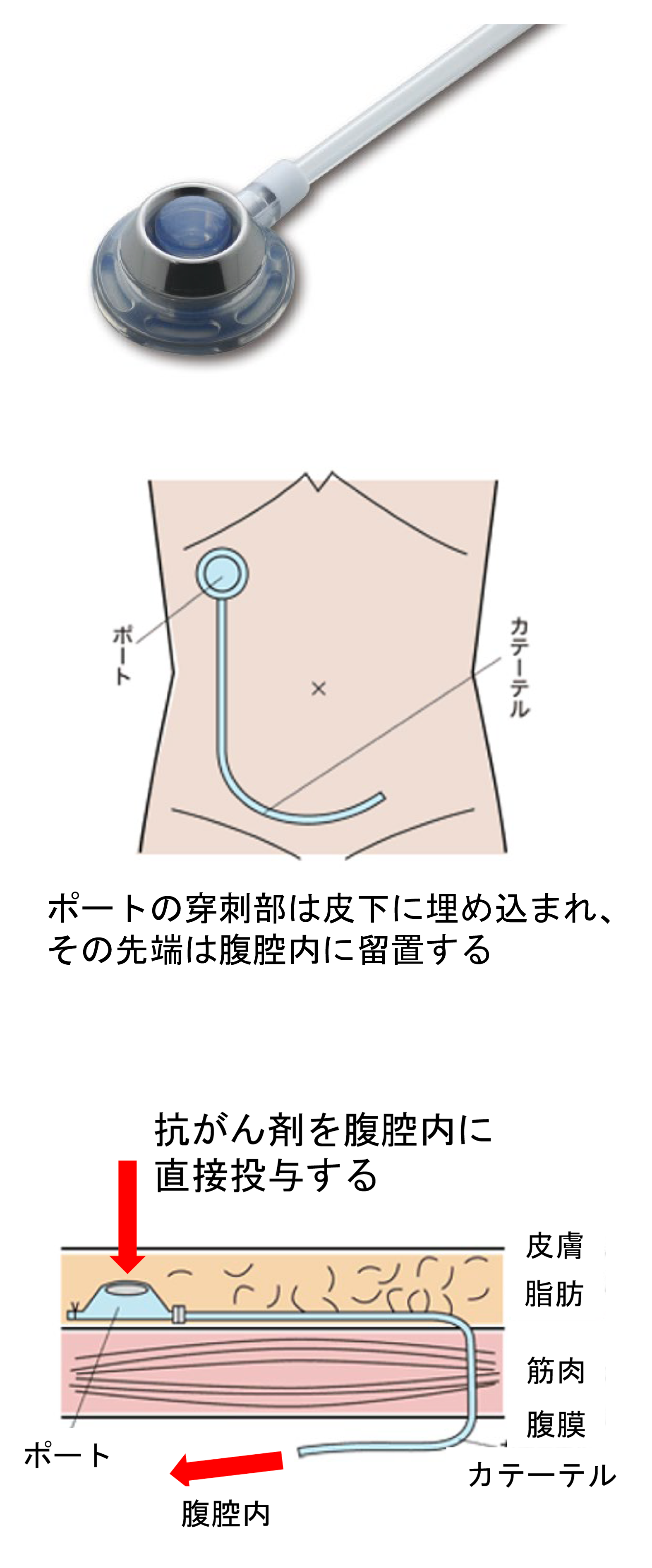 腹腔ポート