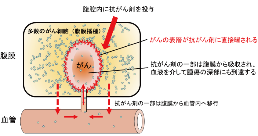 腹腔内抗がん剤治療