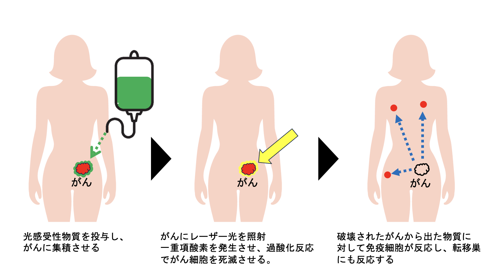 光がん免疫治療法