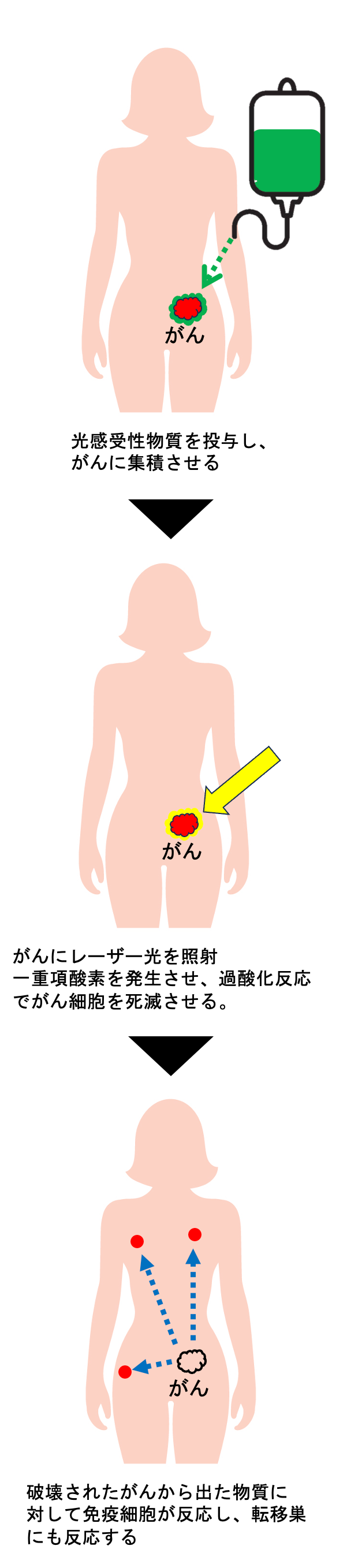 光がん免疫治療法